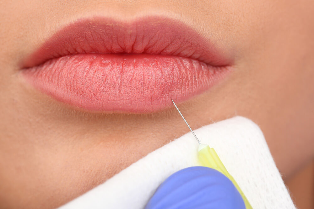 Inyección ácido hialurónico en labios Ácido hialurónico en labios: pros y contras