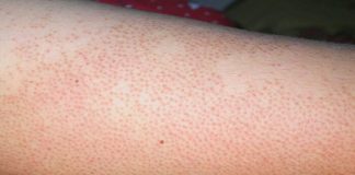 Qué le ocurre al cuerpo tipos de alergias