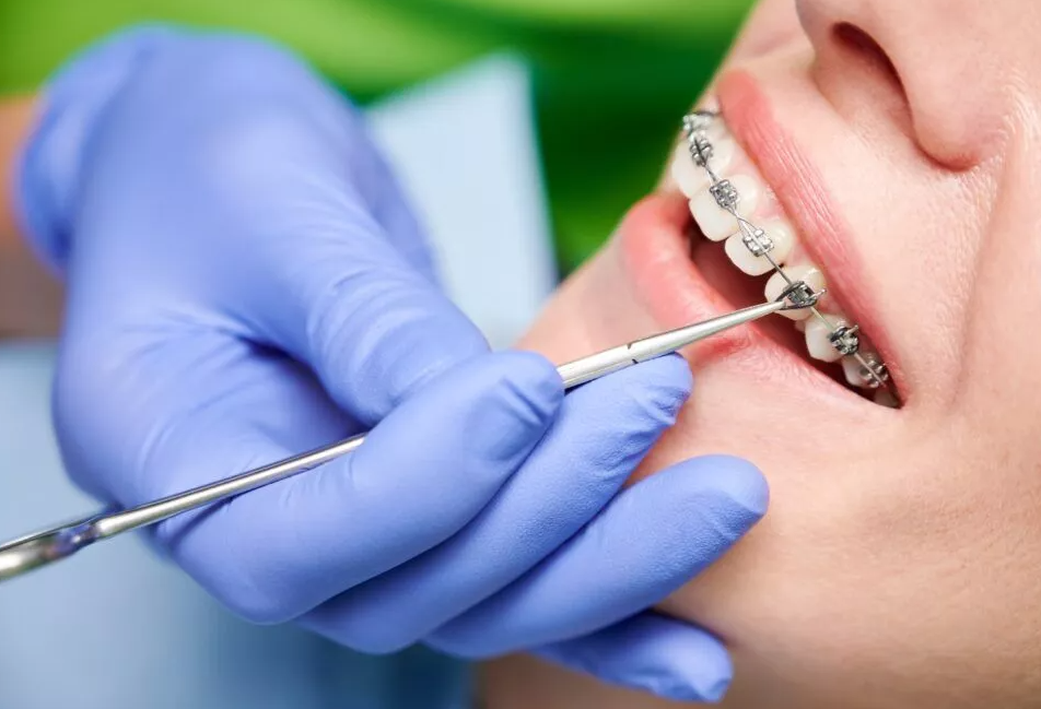 que es la ortodoncia tipos tratamientos ¿Qué es ortodoncia y para qué sirve? Tipos de ortodoncia