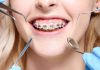 Cuáles son los tipos de ortodoncia